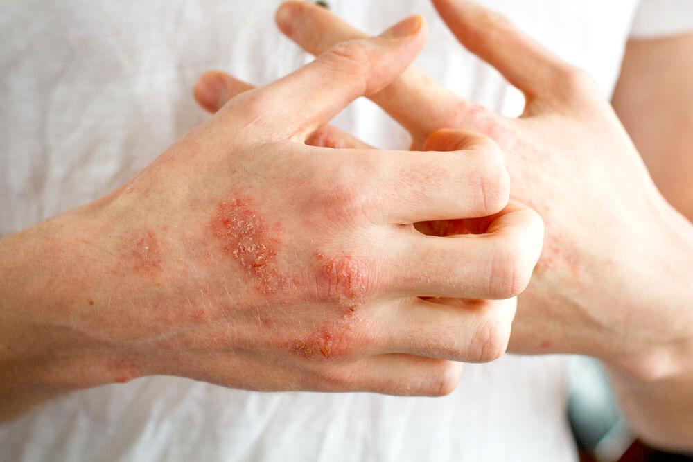Hands with eczema flareup, scratching